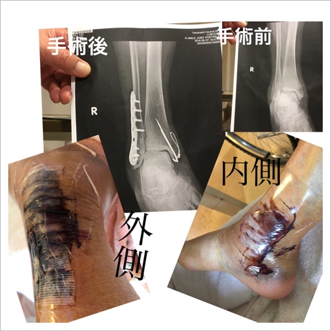 骨折当時の状態 骨折当時の状態